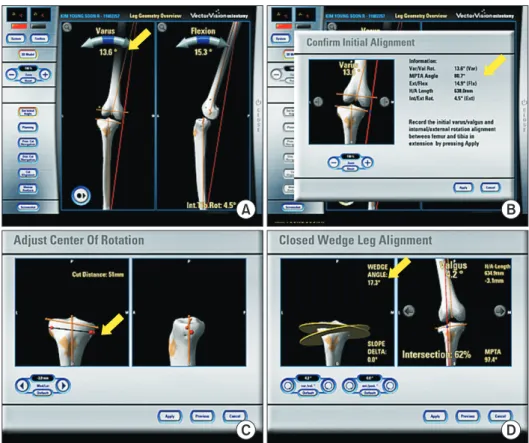 Fig. 1. Computer-assisted closed-wedge  high tibial osteotomy. The navigation  provides information on the deformity (A),  medial proximal tibial angle (B), level of  osteotomy (C), correction angle (D), and  wedge size (arrows).
