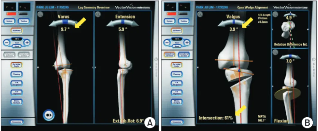 Fig. 5. Computer-assisted open-wedge  high tibial osteotomy. (A) The navigation  system provides information concerning  the deformity, medial proximal tibial angle,  level of osteotomy, and correction angle  (arrows)