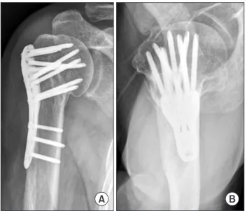 Fig. 1. Immediate postoperative radiographs. (A) Anteroposterior view. 