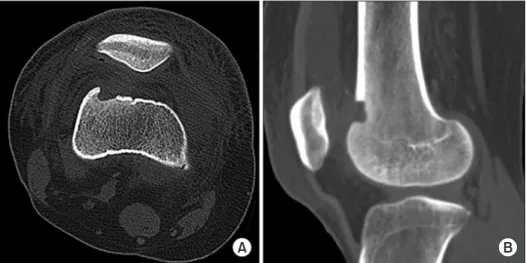 Fig. 5. Axial (A) and sagittal (B) post - -op e  rative  computed  tomography  images  showing the correct location of the removed  lesion and complete nidus removal