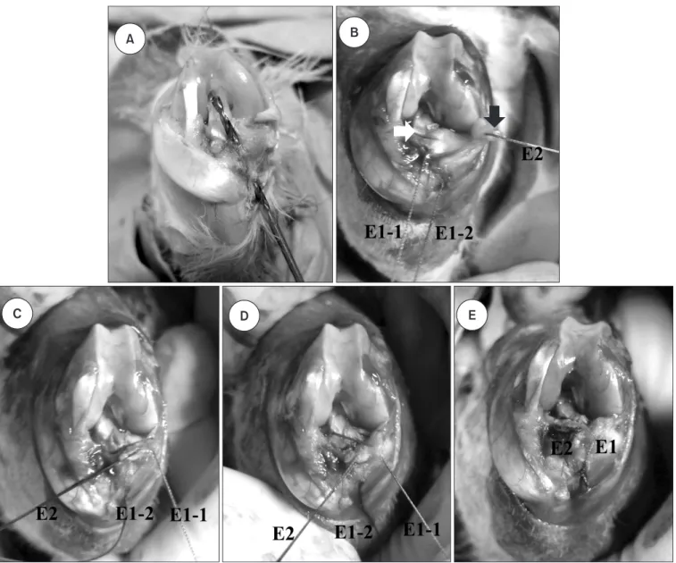 Fig. 2. Th e torn anterior horn of medial meniscus (MM) was reattached by a pullout suture technique
