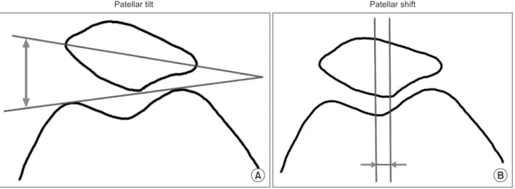 Fig. 2. Patellar tilt (A) and patella shift (B) were measured from the skyline view.