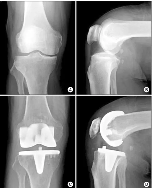 Fig. 2. (A) Preoperative X-ray of an osteo- osteo-arthritis (OA) patient: right knee  antero-posterior (AP) view shows medial joint  space narrowing and varus deformity