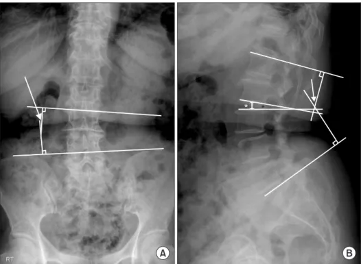 Fig. 1. Measurements of radiological  parameters. (A) The horizontal tilt was  measured as the angle between the  upper end plates of the superior  instru-mented vertebra (SIV) and the lines  linking the top of both iliac crests on  the lumbar standing ant