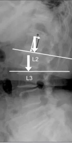 Table 2. The Differences between the Good Group and the Bad  Group and Results of Univariate Analysis to Search for  Factors Associated with Surgical Outcomes of Multi-Level  Lumbar Posterolateral Fusions
