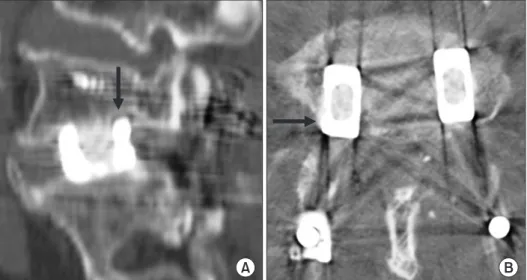 Fig. 3. Postoperative sagittal view (A)  and axial view of computed tomography  scan (B) show poste riorly migrated cage  impinging the right side L5 nerve root  (arrows) and causing postoperative  radicular leg pain.
