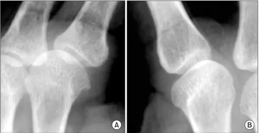 Fig. 2. Height of metacarpal head osteophytes of the index finger. The  osteophyte height is defined as the distance between the base of the  condyle and the most prominent radial margin of the osteophyte (arrow)