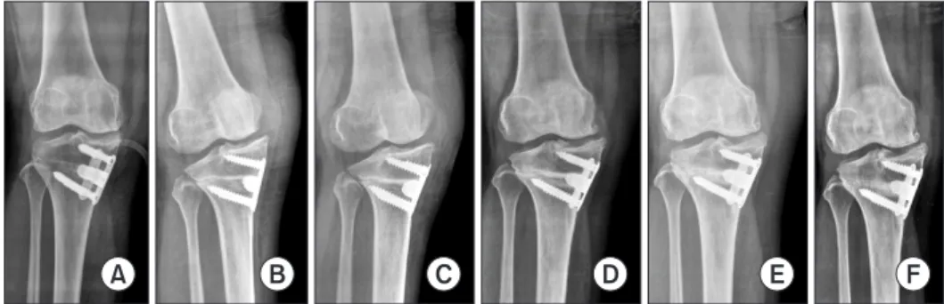 Fig. 3. Delayed union was observed in the  Aescula plate group: (A) immediately after  surgery, (B) at 3 months postoperatively,  (C) at 5 months postoperatively, (D) at 9  months postoperatively, (E) at 14 months  postoperatively, and (F) at 20 months  po