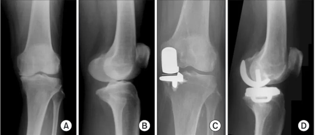 Fig. 1. (A, B) Preoperative radiographs of  a 75-year-old woman show osteoarthritis  of the medial compartment in the left  knee