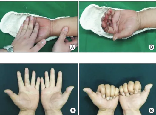 Fig. 7. Postoperative motion: full passive  digital flexion (A) is done first, followed by  partial active motion (B) in the first 3 weeks