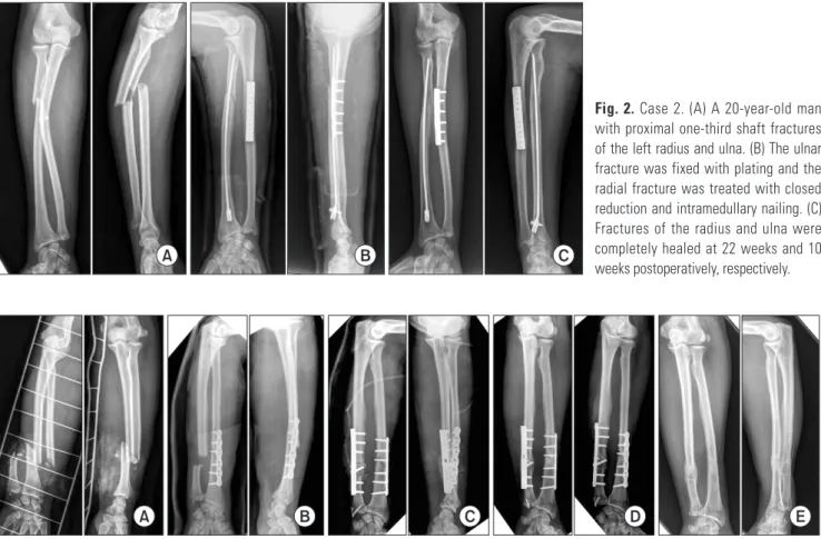 Fig. 2. Case 2. (A) A 20-year-old man  with proximal one-third shaft fractures  of the left radius and ulna