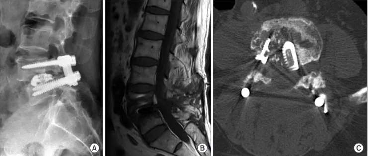 Fig. 3. A typical case of organ/space infection. (A) The simple lateral radiograph of spondylitis shows osteolysis of both facing end plates, migration  of cages, and loosening of pedicle screws