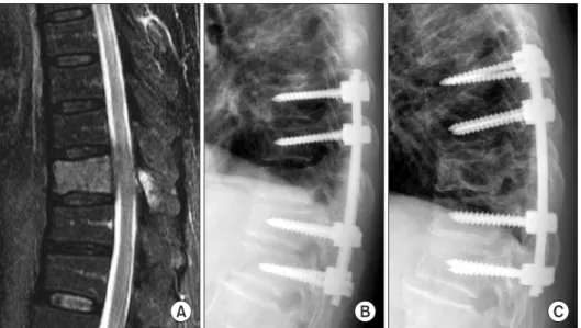 Fig. 1. A 45-year-old man was diagnosed  with non-small cell lung cancer. He  pre-sented with intractable back pain and  progressive lower extremity weakness  (Karnofsky performance status 30% and  Frankel D)