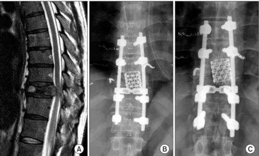 Fig. 2. A 73-year-old man was diagnosed  with non-small cell lung cancer. He  pre-sented with intractable back pain and  progressive lower extremity weakness  (Karnofsky performance status 70% and  Frankel E)