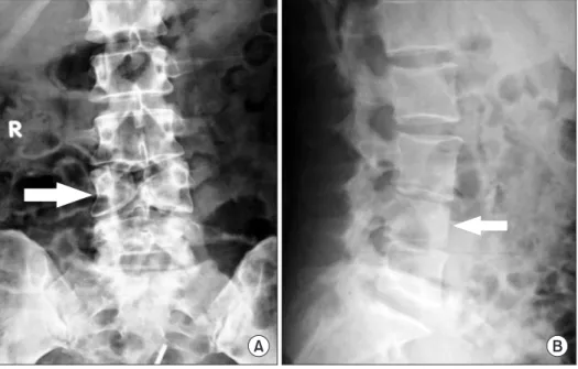 Fig. 2. (A) Axial computed tomography (CT) scan of the L4 butterfly vertebra (osseous window)