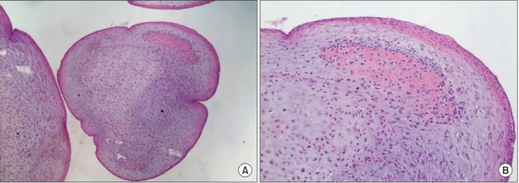 Fig. 3. Low magnification (H&amp;E, ×10) (A) and higher magnification (H&amp;E, ×40) (B) of the representative histology of the tumor, indicating both mature and  immature cartilage formation surrounded by fibrous tissue