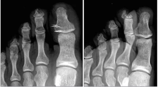 Fig. 2. Coronal T1-weighted (A), sagittal  T2-weighted (B), and sagittal  gadolinium-enhanced fat-saturated T1-weighted (C)  magnetic resonance imaging scans of the  left foot showing the approximate 0.7 ×  0.6 × 0.5 cm well-marginated osteolytic  lesion a