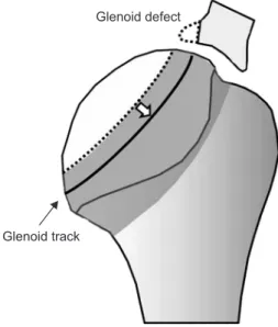 Fig. 4. Glenoid track in a case with glenoid defect. In a case with glenoid  defect, the width of the true glenoid track (black line) is decreased