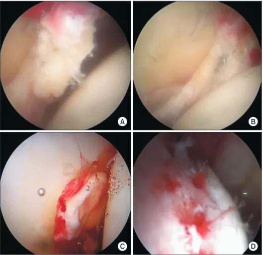 Fig. 1. A 50-year-old male who had  traumatic hip dislocation underwent  arthro scopic treatment