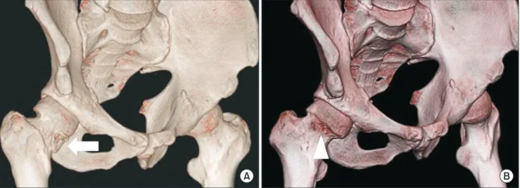 Fig. 2. Pre- and postoperative three-dimensional computed tomography (3D CT) images. (A) Preoperative 3D CT image shows loose body on femoral  head and neck (arrow)