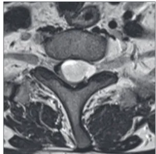 Fig. 1. Axial T2-weighted magnetic resonance imaging scan at the T1  spinal level showing a hypointense mass surrounded by an isointense  signal severely compressing the spinal cord on the left side.
