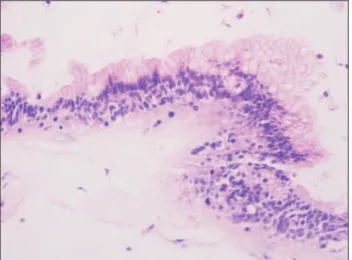 Fig. 3. Intraoperative photograph after the first drainage of clear fluid. 