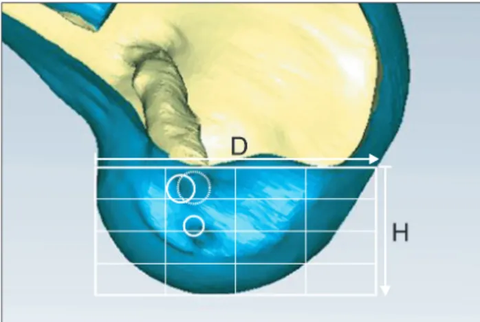 Fig. 2. A view of the lateral femoral condyle in a strictly lateral position,  with both condyles superimposed, was obtained from the  three-dimen-sional model using the Geomagic program