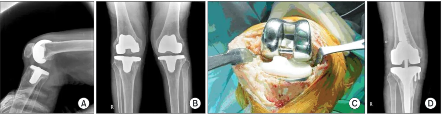 Table 3. Classification of Unstable Total Knee Arthroplasties  According to Causes 