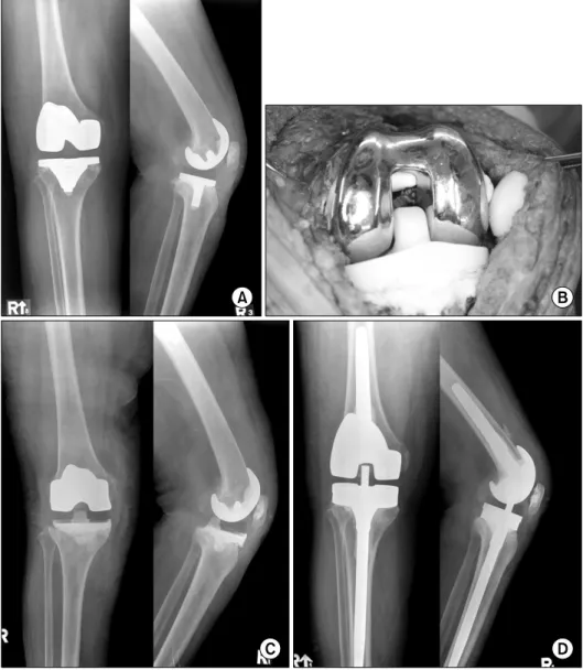 Fig. 1. (A) Preoperative ante- ante-roposterior  and  lateral   radio-graphs of a 69 years old female who had complained persistent  pain after  total  knee   arthro-plasty show periprosthetic  oste-olytic lesions