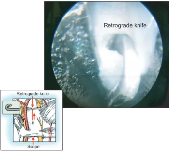 Fig. 4. Transection of the transverse carpal ligament by using a  retrograde knife.