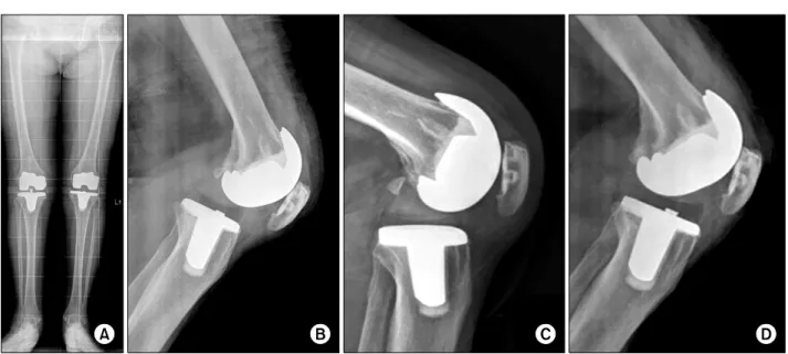 Fig. 1. (A) Standing-extrimity radiograph of the first case. (B) Radiography showing the posterior dislocation of total knee  replacement