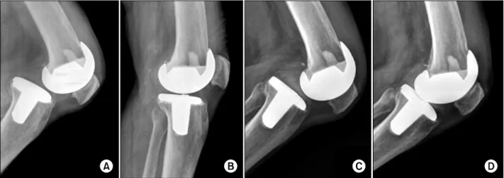 Fig. 2. (A) Lateral radiograph of the left knee of the second case, showing the posterior dislocation of total knee replacement