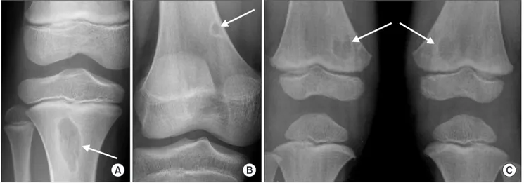 Fig. 2. Epiphyseal cortical irregularity showing a fragmented appearance  on the medial side of the epiphysis in the distal femur.
