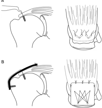 Fig. 1. Schematic illustrations of the mini-open suture bridge technique  with porcine dermal patch augmentation
