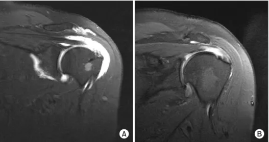 Fig. 1. (A) The oblique coronal T1-wei- T1-wei-ghted  image  of  magnetic  resonance  arthrography (MRA) with fluid signal  transver sing full-thickness of the tendon  shows a full-thickness tear of the rotator  cuff