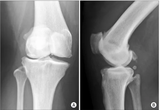 Fig. 2. Postoperative radiograph of the right knee. Lateral view shows the  cementless mobile-bearing total knee prosthesis and dense bone 1 day  after surgery