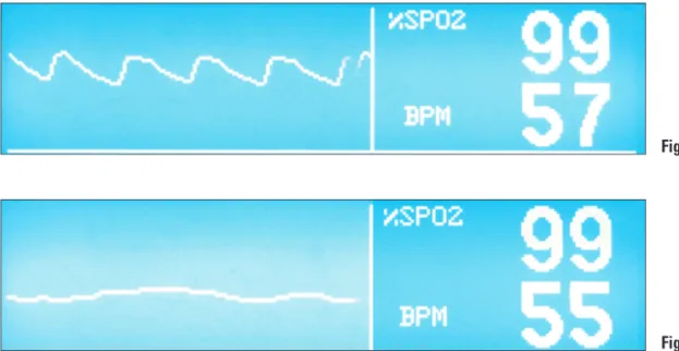 Fig. 1. Good waveform on pulse oximeter.