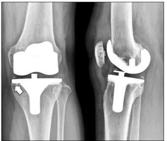 Fig. 2. The anteroposterior and lateral radiographs showed  non-progressive  radiolucent  line  at  medial  side  of  tibial  component  and  anterior  and  posteiror  flange  of  femoral  component.
