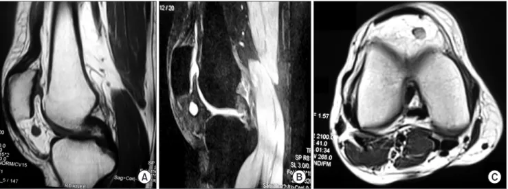 Fig. 2. (A) Intraoperative arthroscopic  view showing a pedunculated reddish  brown nodule arising from Hoffa’s fat  pad