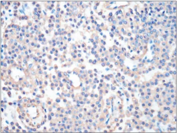 Fig. 4. Immunohistochemistry for smooth muscle actin showing diffuse  cytoplasmic positivity (×20).