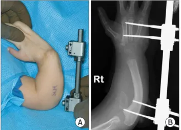 Fig. 1. The metatarsal phalangeal joint transfer procedure begins with  the placement of an external distraction device