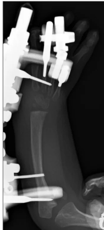 Fig. 2. Planning for distraction includes radiographic templating after the  distraction device is in place