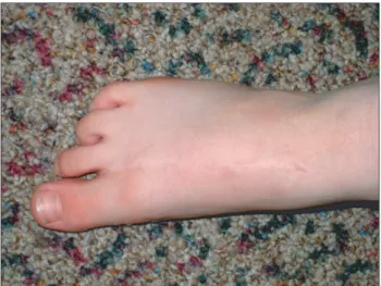 Fig. 4. Final appearance of the foot 2 years after toe harvest. 