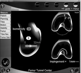 Fig. 12. Femoral tunnel was created at the most isometric  point (as 3 mm of isometricity) displayed by navigation