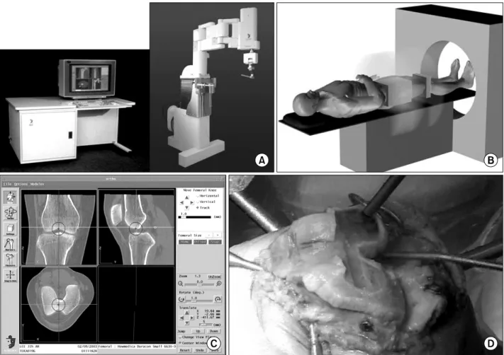 Fig. 1. Photographs of Robodoc Ⓡ  system. Processing is B→D. (A) appearance, (B) CT scanning, (C) planning, (D) milling; 