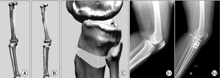 Fig. 7. Virtual surgery of open-wedge HTO. A 3-dimensional surface model of the leg before (A) and after surgery (B)