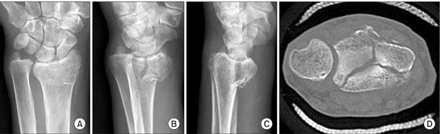 Table 2. Mean Gap and Step-off of AO Type C2 and C3 Measured by  Computed Tomography Distance (mm) C2 C3 p -value Axial gap   1.45   2.46 0.001 Axial step-off 0.5 1.2 0.004 Sagittal gap 1.6   2.66 0.001 Sagittal step-off   0.81   0.91 0.081