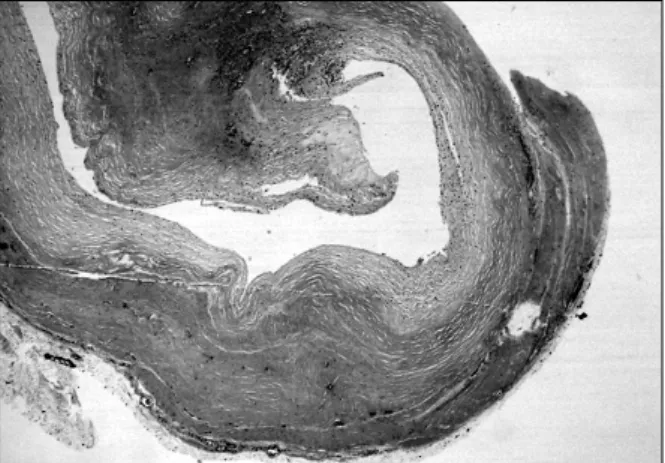 Fig. 4. Light micrograph demonstrates thick walled cystic  space and characteristic focal myxoid change in the matrix  (H&amp;E stain, ×40)  소 소견을 보였다