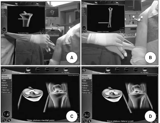 Fig. 1.  Registration  for  the  navigation  was  made  on  tibial  tuberosity  (A),  distal  1/3  of  anterior  tibial  crest  (B),  medial  tibial plateau (C) and lateral tibial  plateau (D).정성을 비교한 연구가 주로 보고되고 있으며, 최근에 in vitro상에서 슬관절 굴곡 정도에 따라 회전 안정성 측