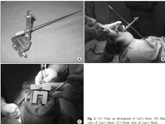 Fig. 1. (A) Close up photograph of Lee’s block. (B) Side  view of Lee’s block. (C) Front view of Lee’s block